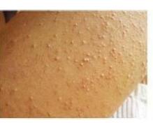 ë�ܽǻ�֢��������Ҫע��Щʲô