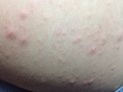 天津过敏性皮炎治疗