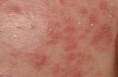 �������Ƥ�׵�ҽԺ�ļҺ�