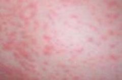 天津治疗皮炎哪个好