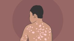 牛皮癣的临床表现都有哪些