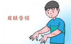 天津看哪里牛皮癣医院好